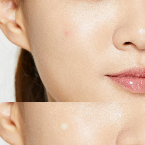Plasturi hidrocoloidali impotriva acneei Acne Pimple, 24buc. | COSRX